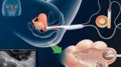 三代试管婴儿整个胚胎发育流程