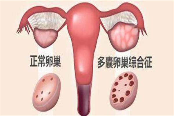 子宫卵巢,试管婴儿,输卵管
