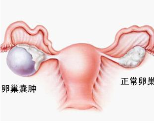 卵巢囊肿,试管婴儿,内分泌失调