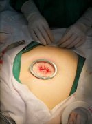 宫腹腔镜手术相关知识？
