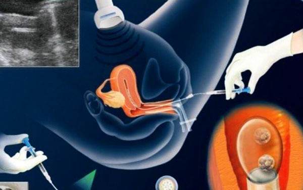 宫外孕,试管婴儿,卵巢早衰,促排,卵泡监测