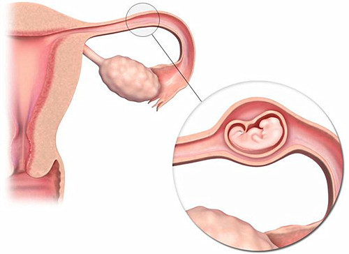 三代试管婴儿,胚胎移植,促排周期,宫外孕