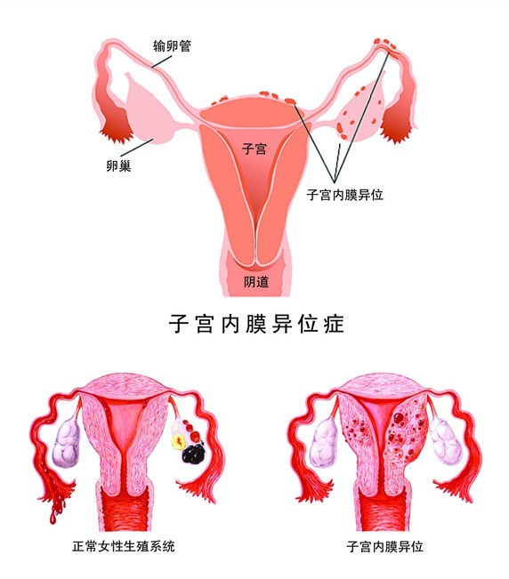 试管婴儿,输卵管积水,胚胎毒性