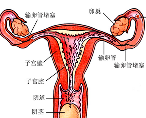 输卵管堵塞,不孕不育,卵巢