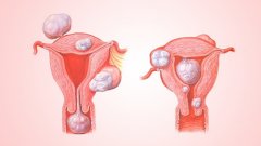 试管遇到子宫肌瘤怎么办？
