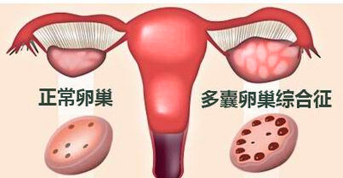 试管婴儿,不孕不育,排卵障碍,卵巢多囊