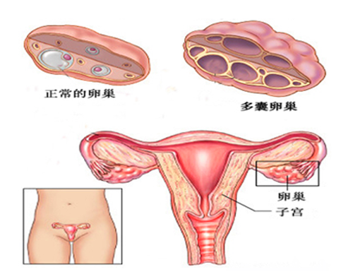 内分泌性不孕,月经不调,多囊卵巢综合症,黄体功能不全