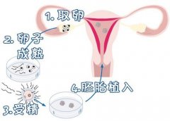 试管婴儿取卵后如何保养卵巢