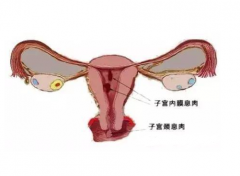 子宫内膜息肉会影响做试管婴儿移植吗