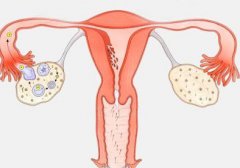 多囊卵巢综合征对试管婴儿有什么影响