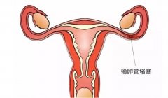 女性要如何预防输卵管堵塞