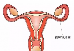 女性输卵管不通一定要做输卵管造影吗