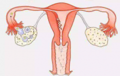 为什么多囊卵巢会导致不孕 受哪些因素影响