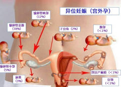 试管婴儿移植后宫外孕什么症状