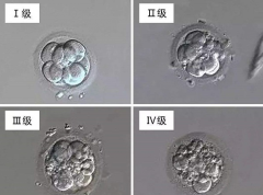 试管婴儿受精卵等级